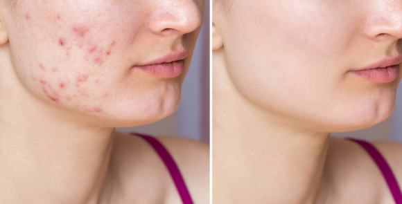 Acne – Rafaela, 25 anos Acne – Rafaela, 25 anos
