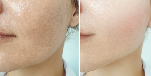 Melasma – Ana Paula, 36 anos Melasma – Ana Paula, 36 anos