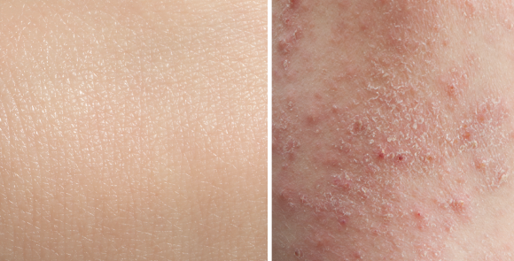 Dermatite – Júlia, 33 anos Dermatite – Júlia, 33 anos
